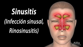 Sinusitis Animación Alila Medical Media Español [upl. by Reimer633]