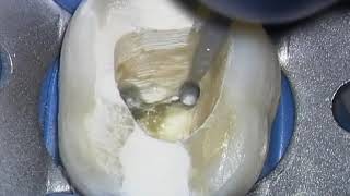 Broken Instrument Removal  Animation amp Clinical Op Sequence Advanced Endodontics [upl. by Oidualc]