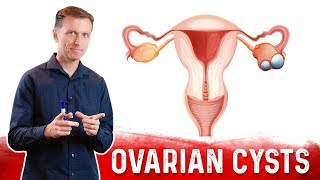 Ovarian Cysts Causes Symptoms amp Natural Treatment – DrBerg [upl. by Nirrok]