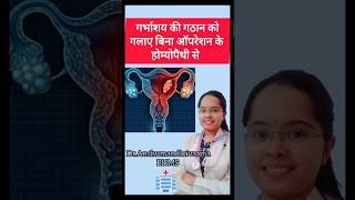 गर्भाशय की गठान को गलाए बिना ऑपरेशन के होम्योपैथी से uterus fibroid uterine dranshumandloivarma [upl. by Peugia]