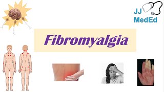 Fibromyalgia  Symptoms Associated Conditions Diagnosis Treatment [upl. by Chrisse]