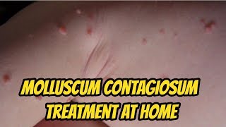 Molluscum contagiosum Treatment At Home [upl. by Diego]