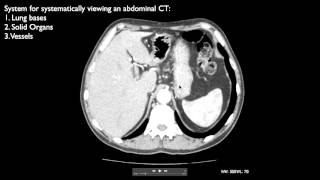 How to interpret an abdominal CT [upl. by Denton4]