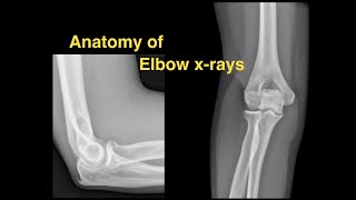 Anatomy of Elbow Xrays [upl. by Eelrebmik38]