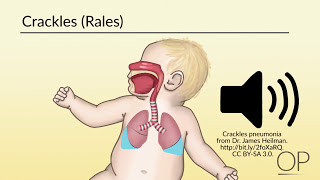 Neonatal Mechanical Ventilation Quick Medical Overview [upl. by Teeter]