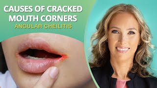 What Causes Mouth Corner Cracks  Angular Cheilitis  Dr J9 Live [upl. by Lleinnad]