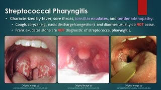 Streptococcal Pharyngitis [upl. by Jud]