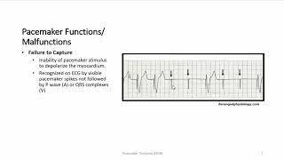 Pacemaker Overview [upl. by Isahella]