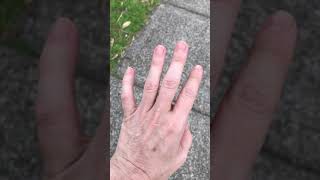 Dystonia with essential tremor [upl. by Spevek]