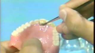 Replacing a Broken Complete Denture Tooth [upl. by Mayrim]