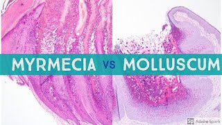 Molluscum vs Myrmecia Wart  Dermpath Lookalikes [upl. by Amesari]