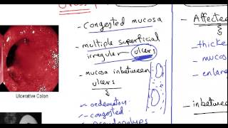 Infectious And Pseudomembranous Colitis [upl. by Saitam]