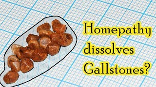 Can homeopathic medicine dissolve gallstones  Dr Sanjay Panicker [upl. by Yort]