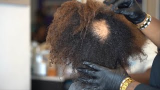 Female Pattern Baldness The ALOPECIA EPISODE‼️ [upl. by Kenley]