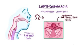 Laryngomalacia causes symptoms diagnosis treatment pathology [upl. by Ientirb234]