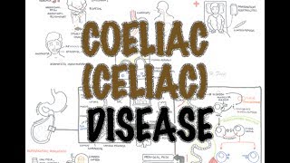 Ulcerative Colitis Clinical features morphology diagnosis treatment [upl. by Acinat366]