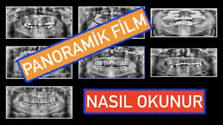 Panoramik Film Nasıl Okunur [upl. by Okihcim]