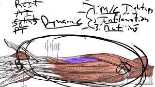 Extensor Tendonitiseasy to get easy to fix [upl. by Dirrej]