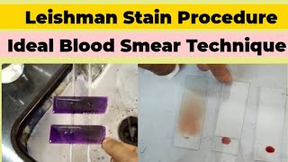 Leishman Stain Procedure and Blood Smear Preparation for DLC Count [upl. by Elie]