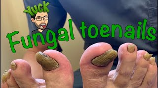 CUTTING LONG TOENAILS WITH FUNGUS [upl. by Laamak]