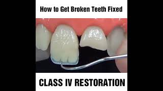 How to fix a chipped cracked or broken tooth MyDentCart  Cracked tooth repair  Broken Tooth [upl. by Coppock]