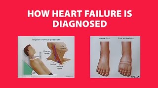 How Heart Failure is Diagnosed [upl. by Cadell]