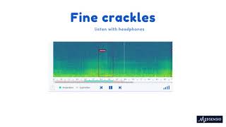 Lung sounds  fine crackles [upl. by Downs]