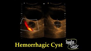 Head Cyst Compilation Live DR Khaled Sadek [upl. by Dauf]