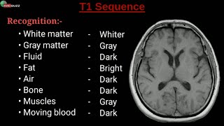 Prostate Cancer Surveillance on MRI [upl. by Nwahsram717]