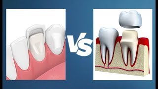 Veneers vs Crowns  Whats the Difference [upl. by Hetti565]