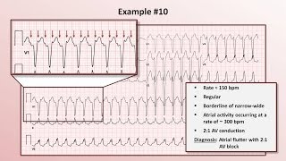 Intro to EKG Interpretation  Practicing Tachyarrhythmia Identification [upl. by Nelleyram324]