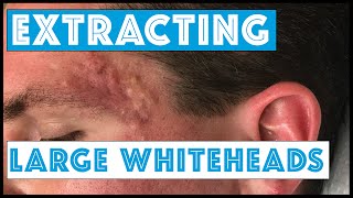 Acne Vulgaris and Extracting large Whiteheads  Part 1 [upl. by Anibla43]