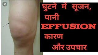 Swelling  edema effusion in Knee joint Hindi  घुटने में पानी भरना सूजन का इलाज knee pain ACL [upl. by Thenna]