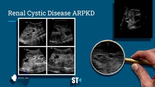 Renal Cysts Ultrasound [upl. by Lotson]