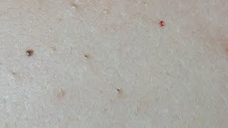 Acne Treatment on the Back Uninfected Lesions [upl. by Nabalas]