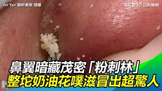 鼻翼暗藏茂密「粉刺林」 一擠整坨奶油花噗滋冒出數量驚人｜三立新聞網SETNcom [upl. by Yromem607]