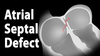 Atrial Septal Defect ASD Animation [upl. by Eahsed]