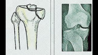 Posteromedial Approach to the Proximal Tibia [upl. by Arawaj784]