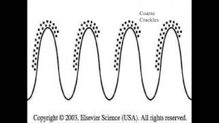 coarse crackles [upl. by Sula]