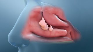 SINUSITIS CRÓNICA  POLIPOSIS NASAL BILATERAL [upl. by Alenas510]