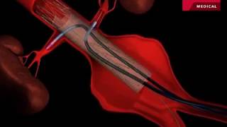 Fenestrated Endovascular Graft to Repair Abdominal Aortic Aneurysm [upl. by Naegem]