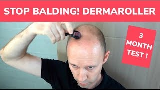 STOP BALDING  Dermaroller 3 Month Test and Tutorial [upl. by Idyak351]