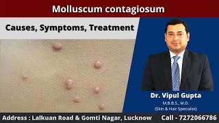 Molluscum contagiosum  Causes Symptoms Treatment [upl. by Ahab]