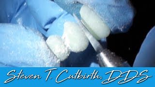 How to Fabricate Temporary Veneers  Dental Minute with Steven T Cutbirth DDS [upl. by Bancroft176]