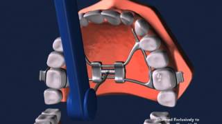 Advanced Orthodontics  Expanders [upl. by Hukill]