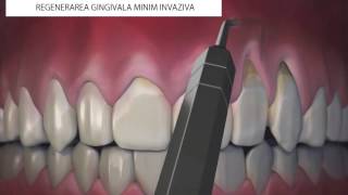 Regenerare gingivala minim invaziva [upl. by Eliathan]