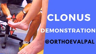 Clonus Demonstration with Ortho Eva Pal [upl. by Yeknarf667]