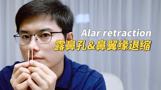 【韩国整形】露鼻孔？鼻修复过程中的鼻翼缘退缩矫正最难做！Alar retractionfeat李朴频道LpChannel [upl. by Duester260]