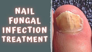 HOW TO TREAT FUNGAL NAIL INFECTION  TINEA UNGUIUM  ONYCHOMYCOSIS [upl. by Tray]