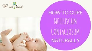 How To Cure Molluscum Contagiosum Naturally [upl. by Valoniah]